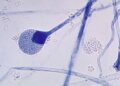 Hongo negro: 6 preguntas clave sobre la rara infección fúngica que ataca a pacientes de covid-19 en India