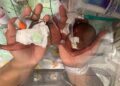 Bebé prematuro rompe record Guinness al pesar 420 gramos