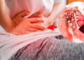 ¿Cuáles son los síntomas de Cáncer de colon y que tan grave es?