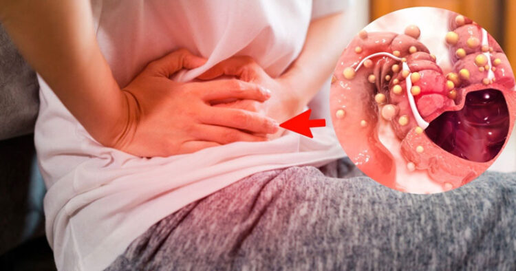 ¿Cuáles son los síntomas de Cáncer de colon y que tan grave es?