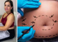 Muere mujer estadounidense tras hacerse una “lipo” en Guadalajara