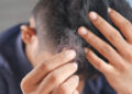 Aprueba EU la primera pastilla contra la alopecia areata