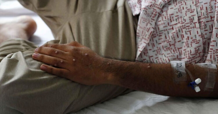 Registran 504 contagios de viruela de mono en México